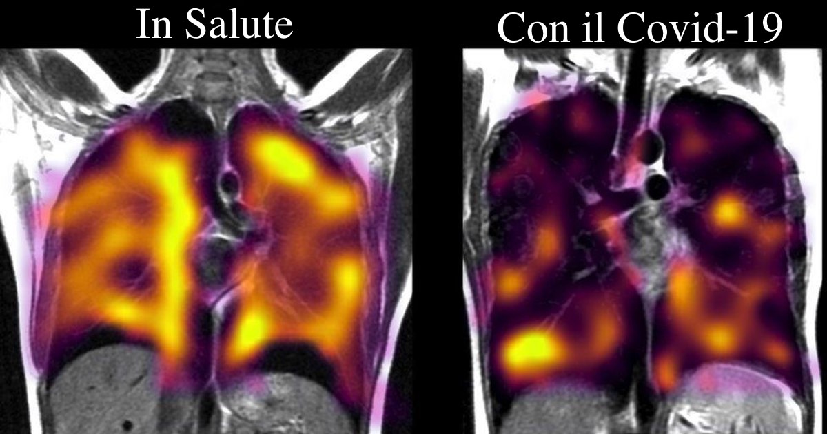 Long Covid, Studio Scopre I Danni Nascosti Ai Polmoni
