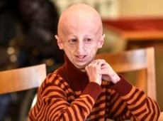 Addio a Sammy Basso, il più longevo malato di progeria